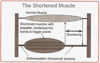 Gunn Intramuscular Stimulation: Is It Right For You?